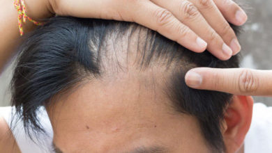 rubrica del benessere - calvizie maschile